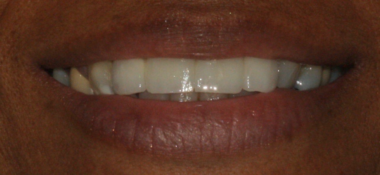 Teeth Restored with Dental Implant Crown and Bridge